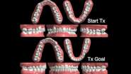 Clear aligner therapy: Begin with the end in mind