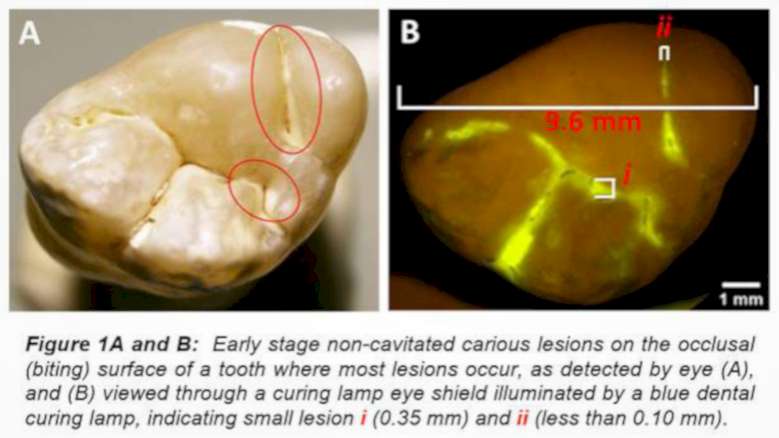 GreenMark to develop technology for early caries detection